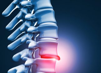 Por que fazer Pilates em caso de hérnia de disco?