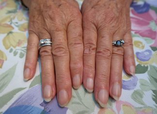 Síndrome das unhas fracas atinge 20% da população