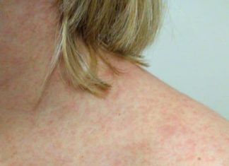 Sete casos de sarampo estão confirmados no Paraná