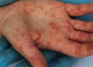 Campanha Nacional de Vacinação contra Sarampo começa nesta segunda-feira, dia 07