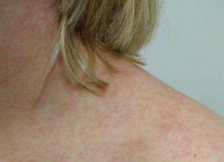 Saúde confirma 36 municípios com surto de sarampo