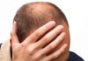 Especialista explica sobre calvície na juventude
