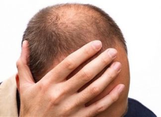 Especialista explica sobre calvície na juventude