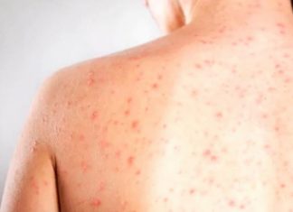 Sarampo cresce no Paraná; vacina é a única forma de prevenção