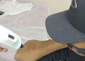 Se arrependeu da tattoo? É seu direito e não precisa conviver com ela na pele