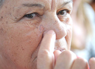 Câncer de pele é tema da campanha Dezembro Laranja