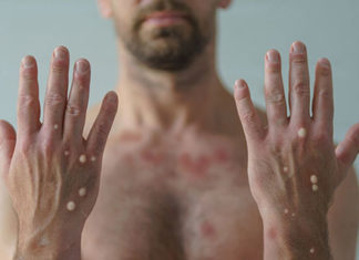 Paraná tem 10 casos confirmados de Monkeypox