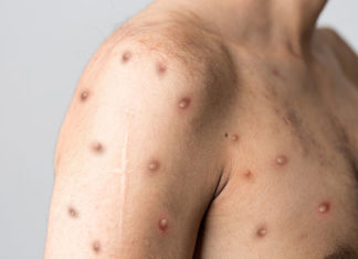 Paraná confirma mais 11 casos de Monkeypox