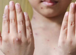 Criança internada em Cornélio Procópio pode estar infectada com a varíola do macaco