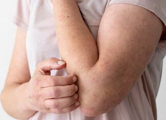 Por que, quando não tratada adequadamente, a hanseníase pode voltar?