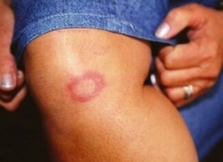 Janeiro Roxo: Secretaria da Saúde reforça conscientização sobre hanseníase