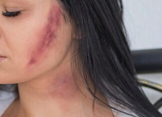 MP denuncia por tentativa de homicídio mulher que jogou soda cáustica no rosto da ex-namorada do companheiro por ciúmes