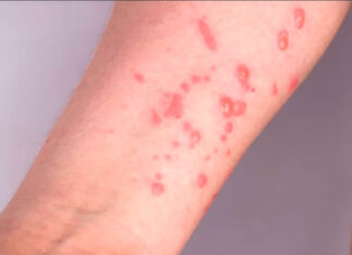 Registrado primeiro caso de Mpox no PR; paciente é morador do Paraguai